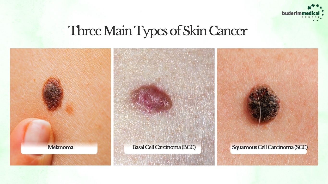 Three Main Types of Skin Cancer