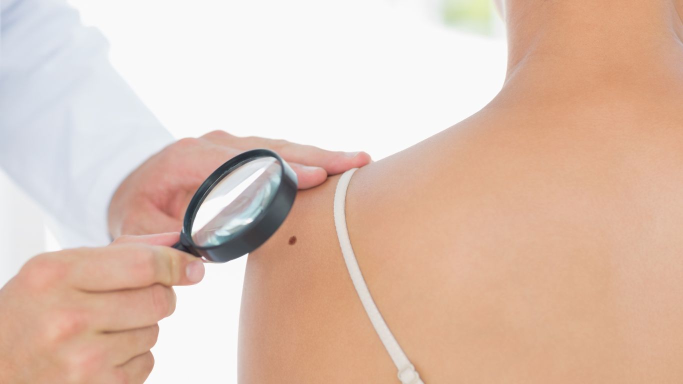 when is a mole consider melanoma